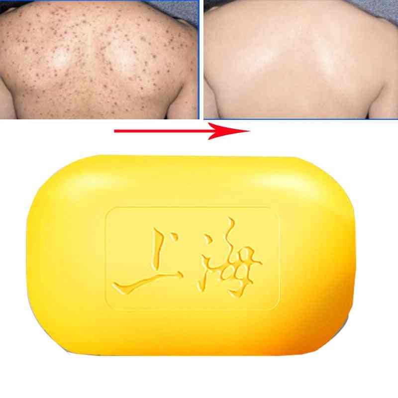 Olie kontrol acne behandling, hudorm remover sæbe - whitening rengøringsmiddel traditionel hudpleje