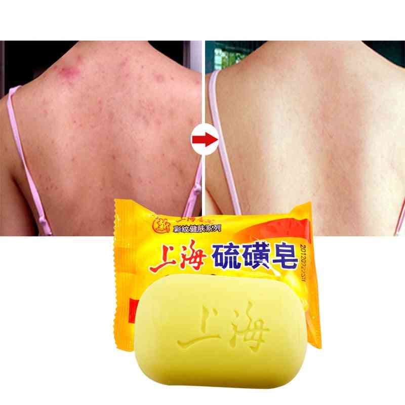 Oil Control Acne Treatment, Blackhead Remover Soap - Whitening Cleanser Traditional Skin Care