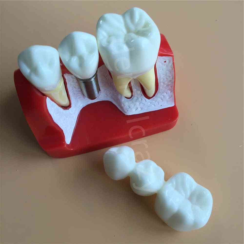 стоматологично обучение имплант анализ коронен мост подвижен модел зъбен демонстрационен модел зъби