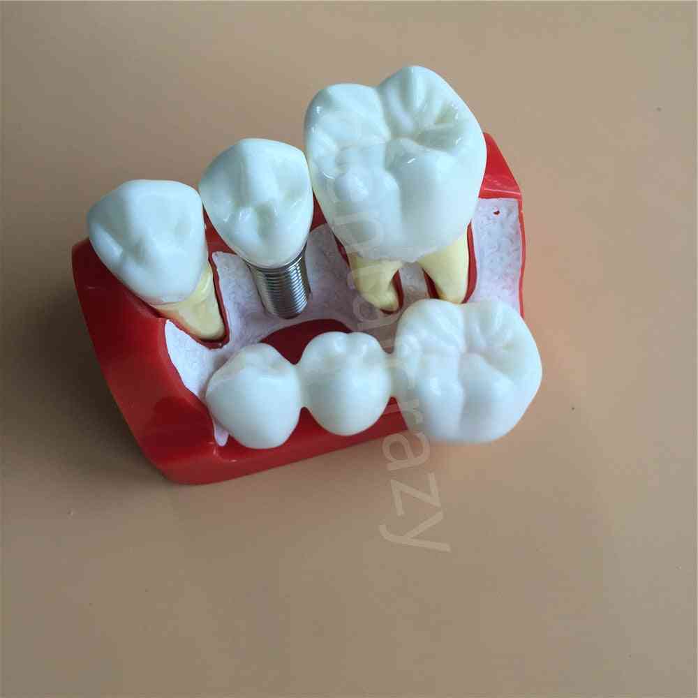 Dental Teach Implant Analysis Crown Bridge Removable Model Dental Demonstration Teeth Model