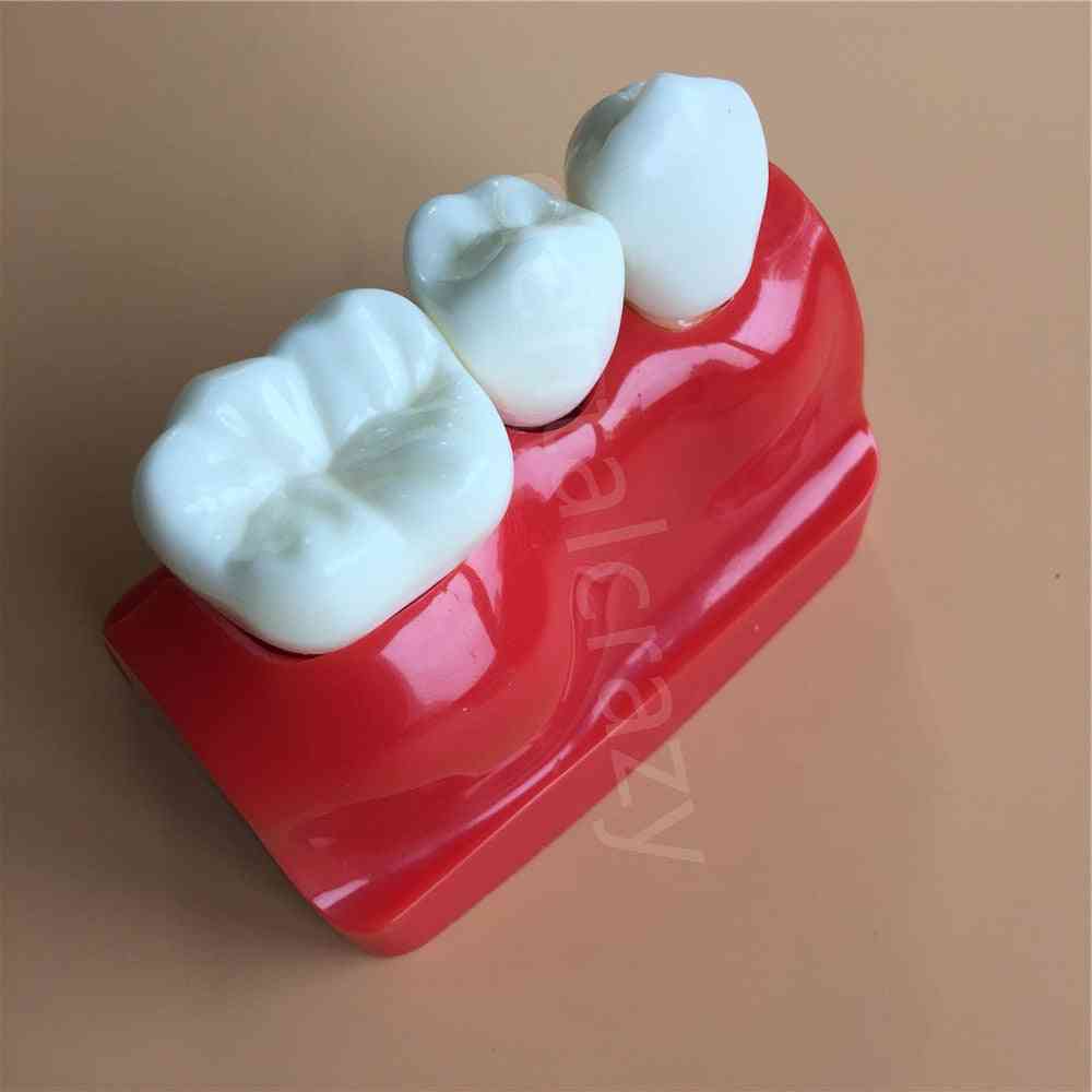 Tandlära implantatanalys krona bridge borttagbar modell tand demonstration tänder modell