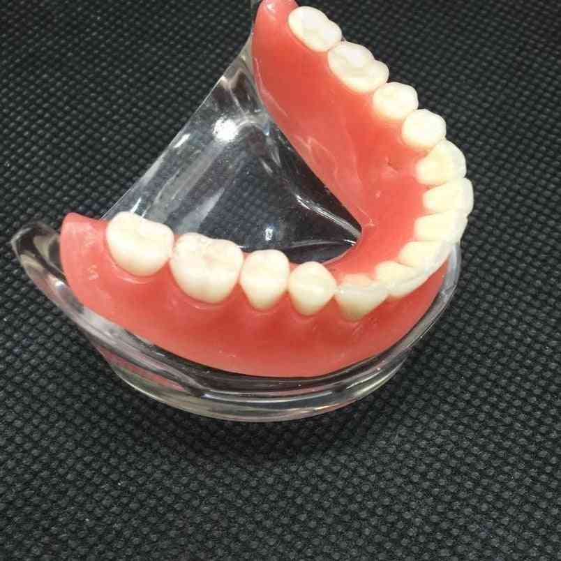 Modelo de dientes inferiores mandibulares interiores de sobredentadura dental con diente de restauración de implante