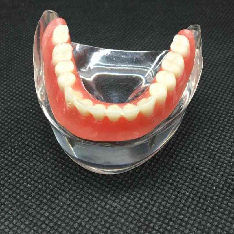 Tandövervakning inre mandibular nedre tänder modell med implantat restaurering tand