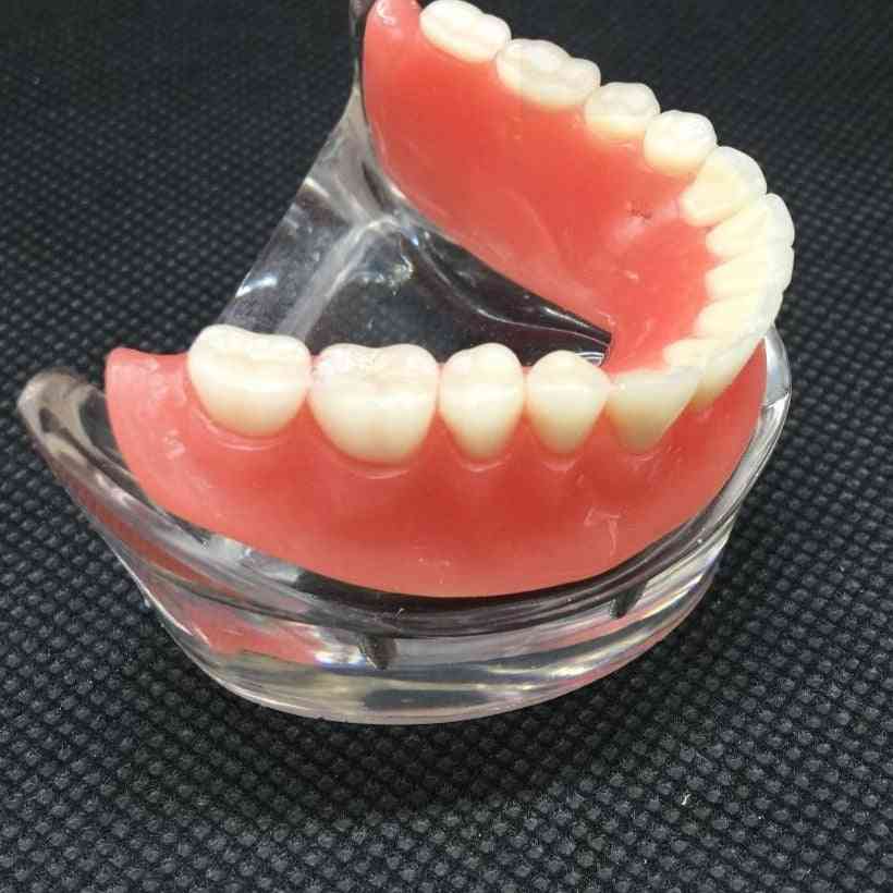 Modelo de dientes inferiores mandibulares interiores de sobredentadura dental con diente de restauración de implante