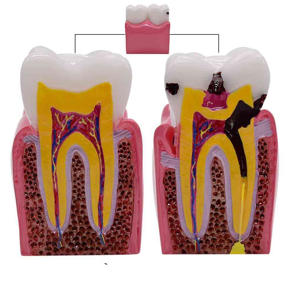 1kom 6 puta modeli za usporedbu karijesa - model propadanja zuba za stomatološki studij koji podučava stomatološku anatomiju
