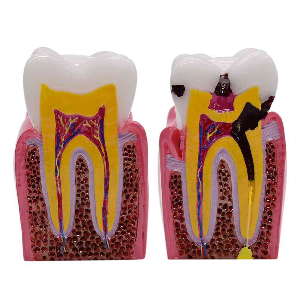 1kom 6 puta modeli za usporedbu karijesa - model propadanja zuba za stomatološki studij koji podučava stomatološku anatomiju