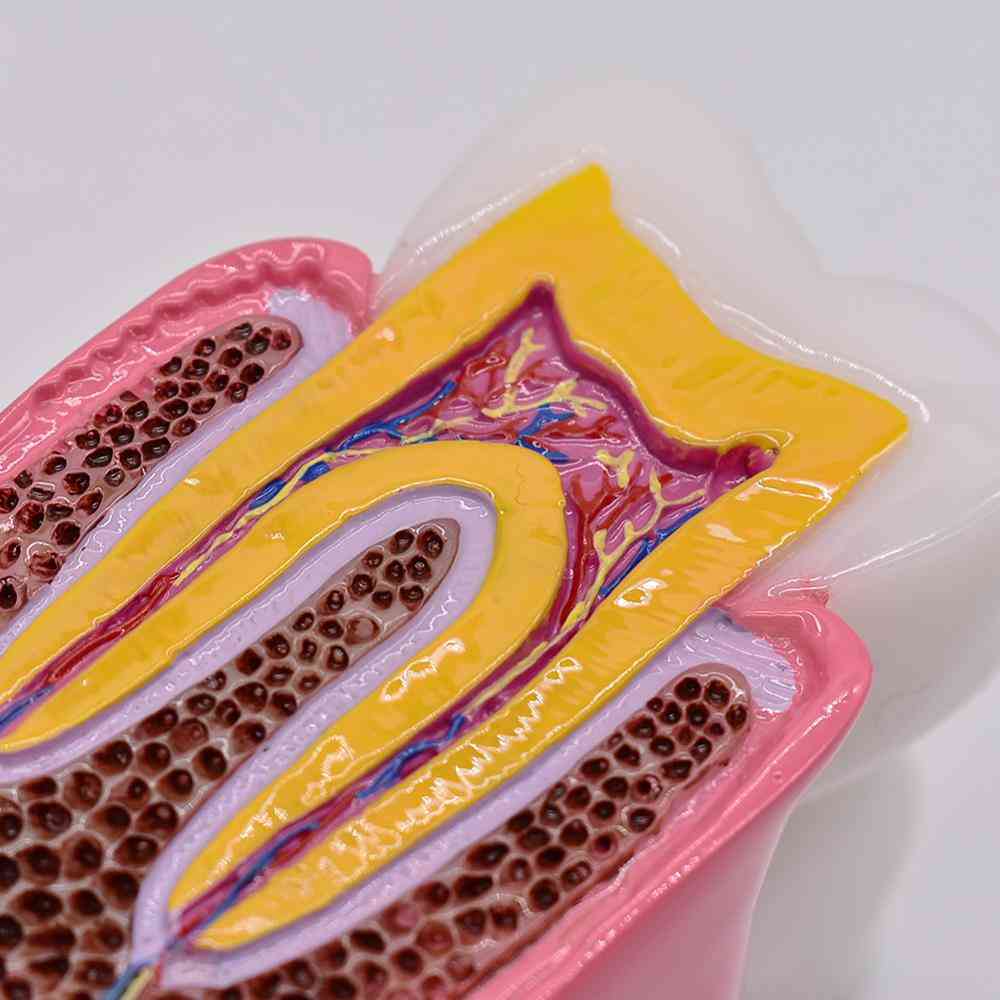 1 st 6 gånger tandkaries jämförelse modeller - tandröta modell för tandstudier undervisning tandläkare anatomi utbildning