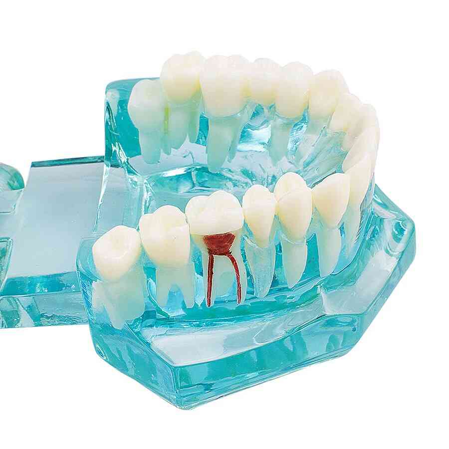 1 stykke voksen dental harpiks restaurering model til tænder undersøgelse, tandlæge værktøjer tandpleje laboratorium gennemsigtig model