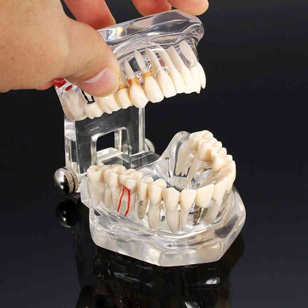 1 Piece Adult Dental Resin Restoration Model For Teeth Study, Dentist Tools Dentistry Laboratory Transparent Model