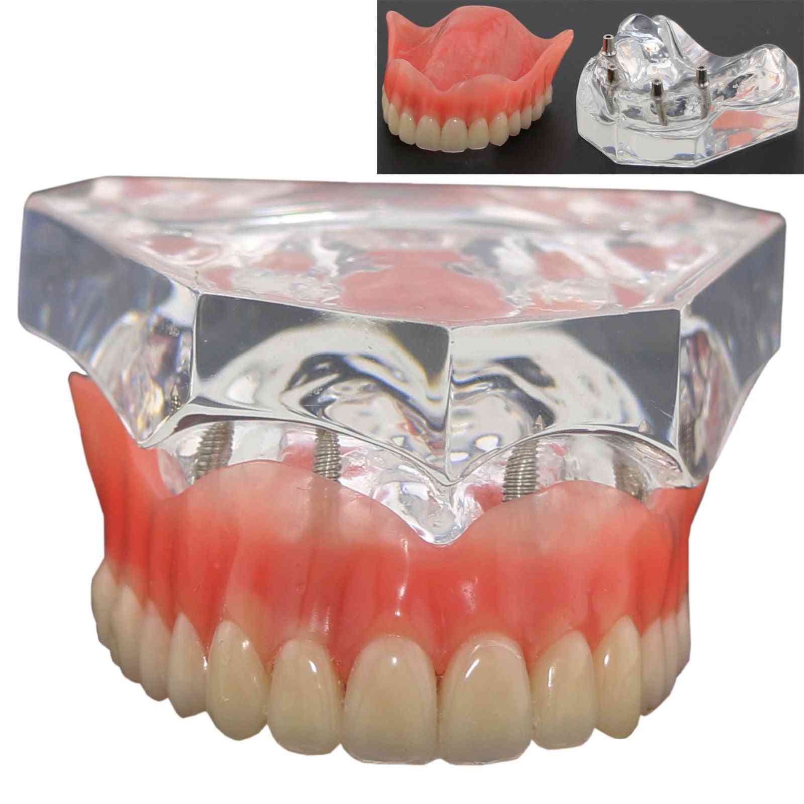 1 pieza sobredentadura superior dental modelo de demostración superior de 4 implantes, modelo de dientes
