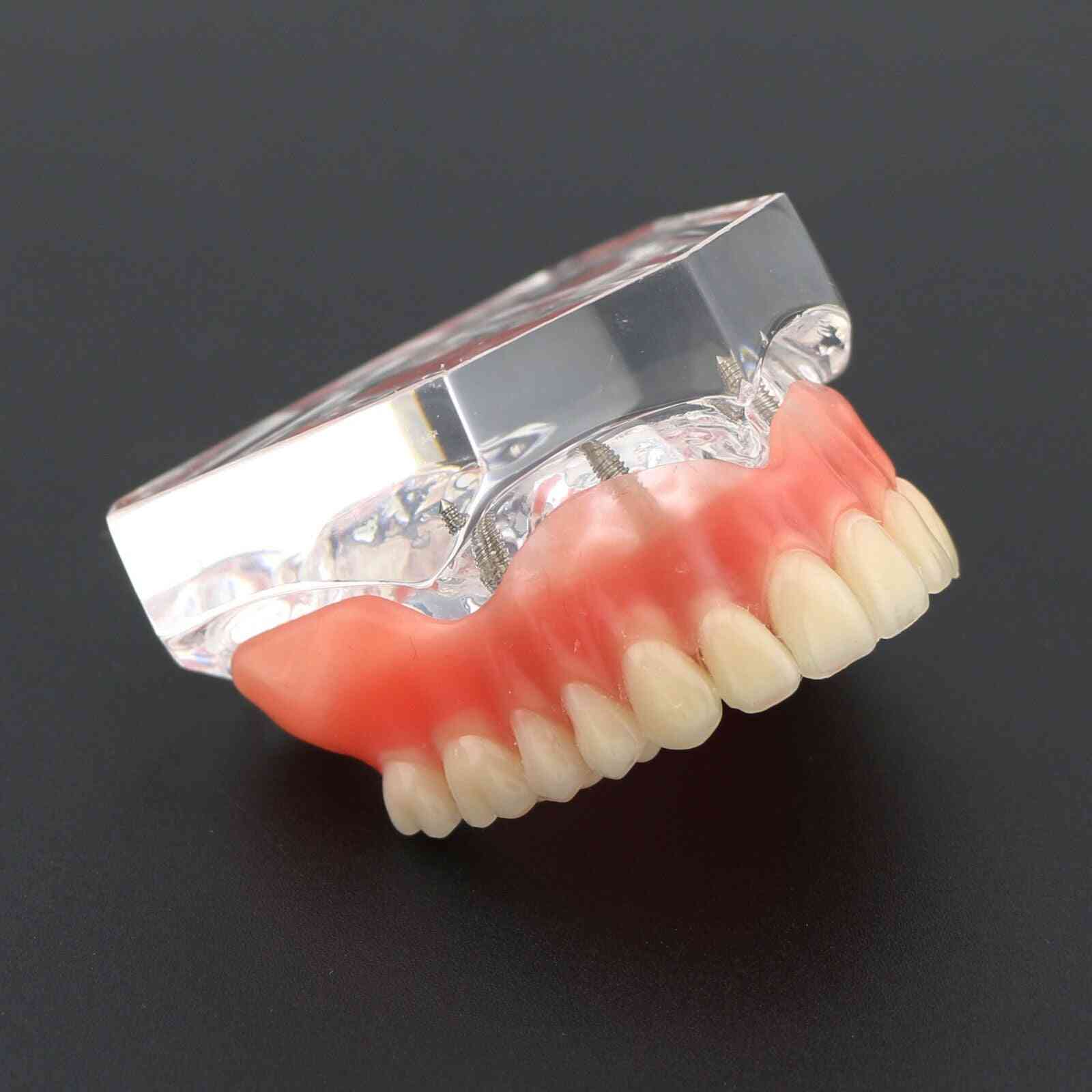 1pcs Dental Upper Overdenture Superior 4 Implants Demo Model, Teeth Model