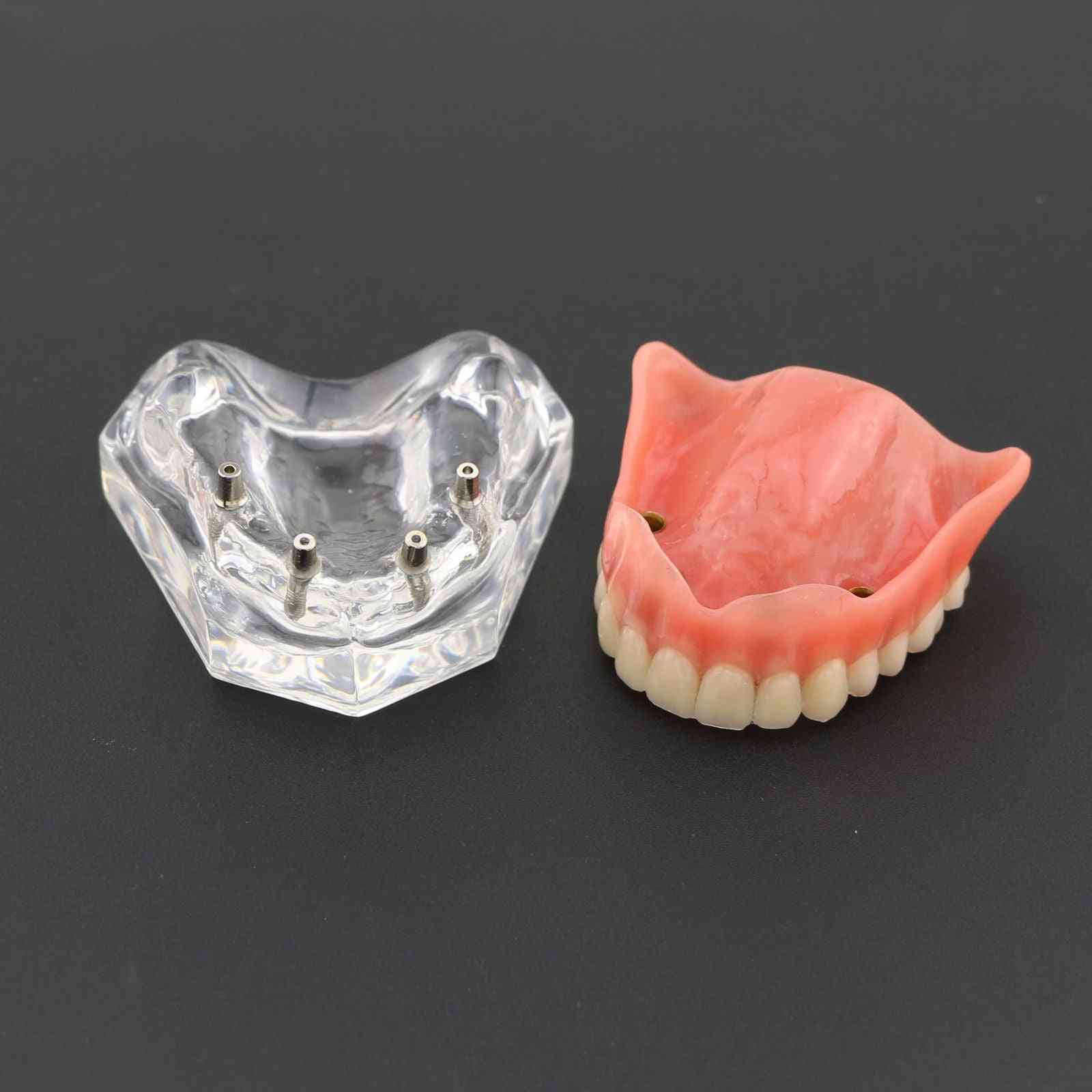 1pcs prothèse dentaire supérieure supérieure 4 implants modèle de démonstration, modèle de dents