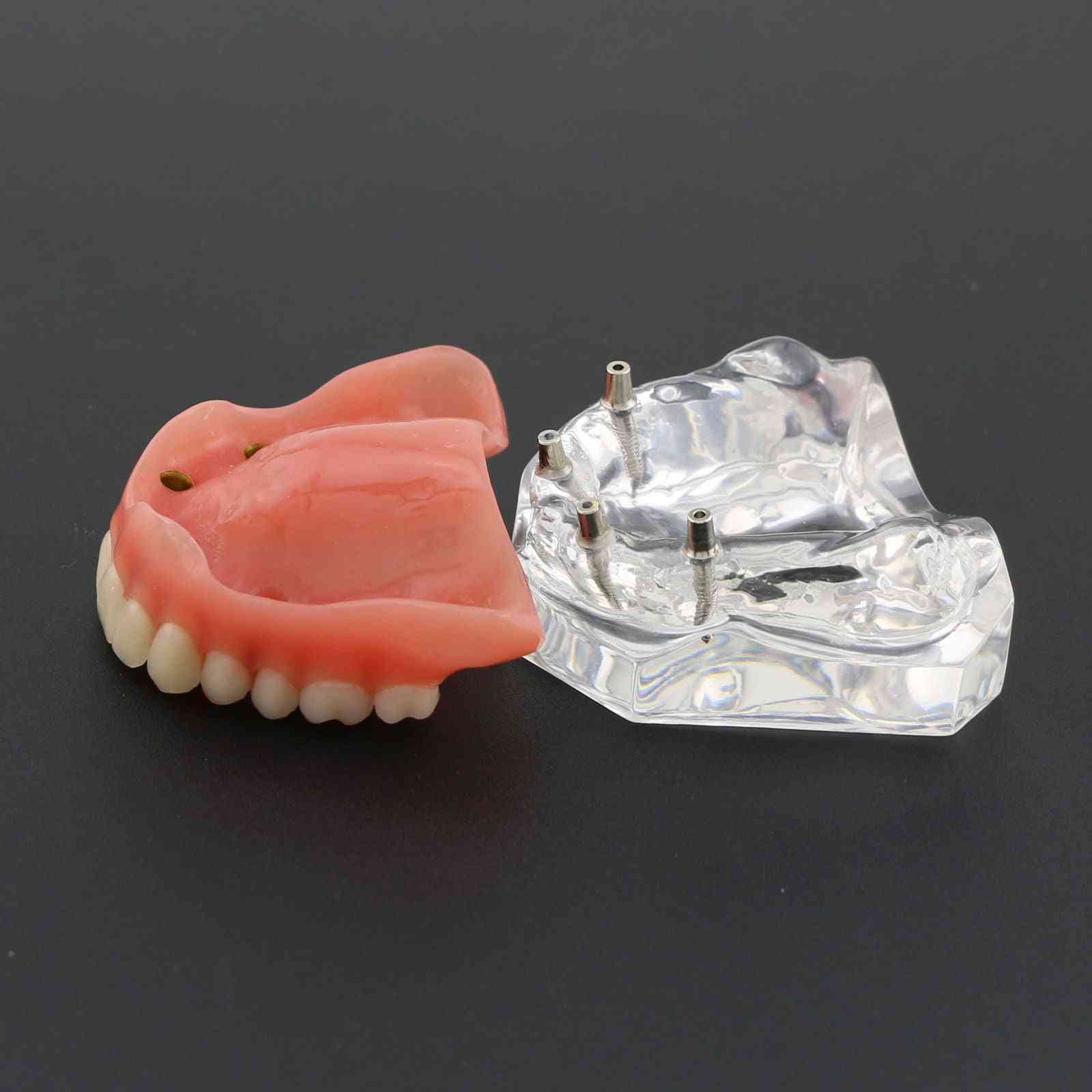 1 pieza sobredentadura superior dental modelo de demostración superior de 4 implantes, modelo de dientes
