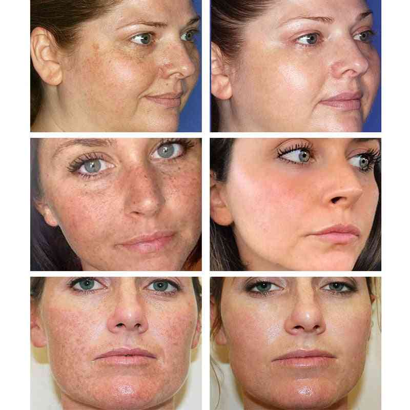 Whitening ansiktskräm reparation blekna fräknar ta bort mörka fläckar melanin remover ljusare ansiktskräm