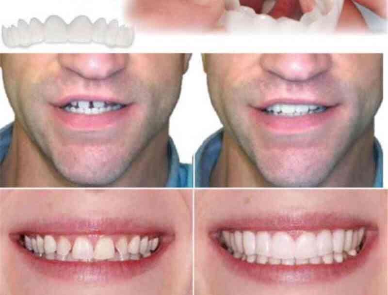 Dientes postizos superiores e inferiores carillas de sonrisa perfecta ajuste cómodo frenillos de pasta de dentadura postiza flexible para doble fila de blanqueamiento