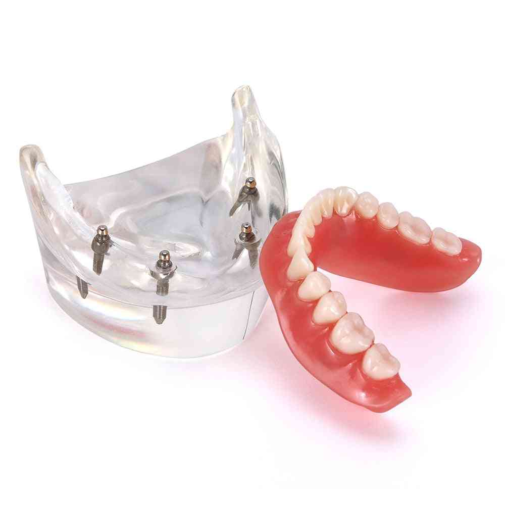 Fogimplantátum fogak- kivehető belső rész implantátumokkal felső, alsó fog tanítása