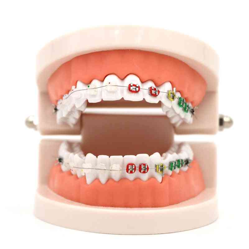 Stomatologiczny model leczenia ortodontycznego z ortometalowym zamkiem ceramicznym