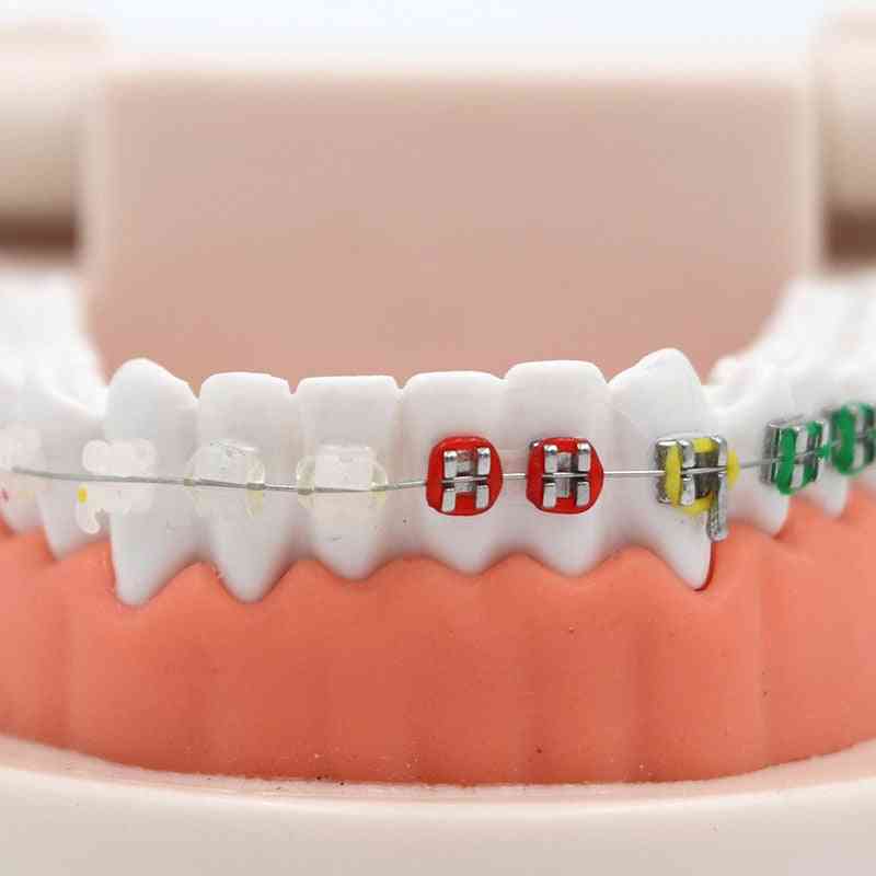 Dental Orthodontic Treatment Model With Ortho Metal Ceramic Bracket