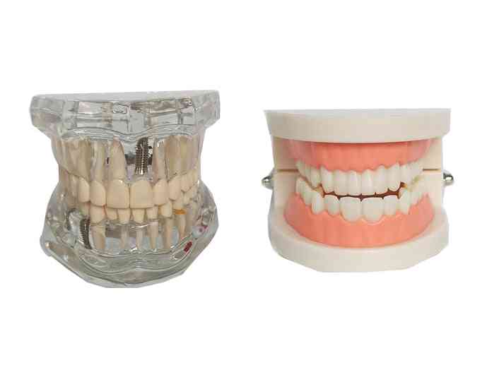 Dental Model Teeth Implant Restoration Bridge Teaching Study Medical Science