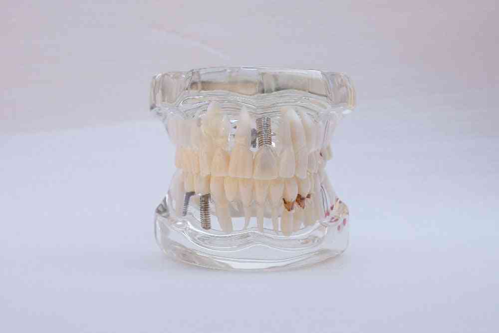 1 stk tannundervisning studiemodell standard restaurering
