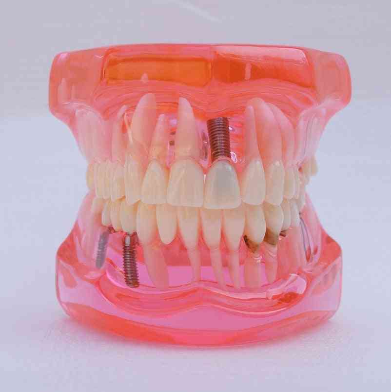 1 stk tannundervisning studiemodell standard restaurering