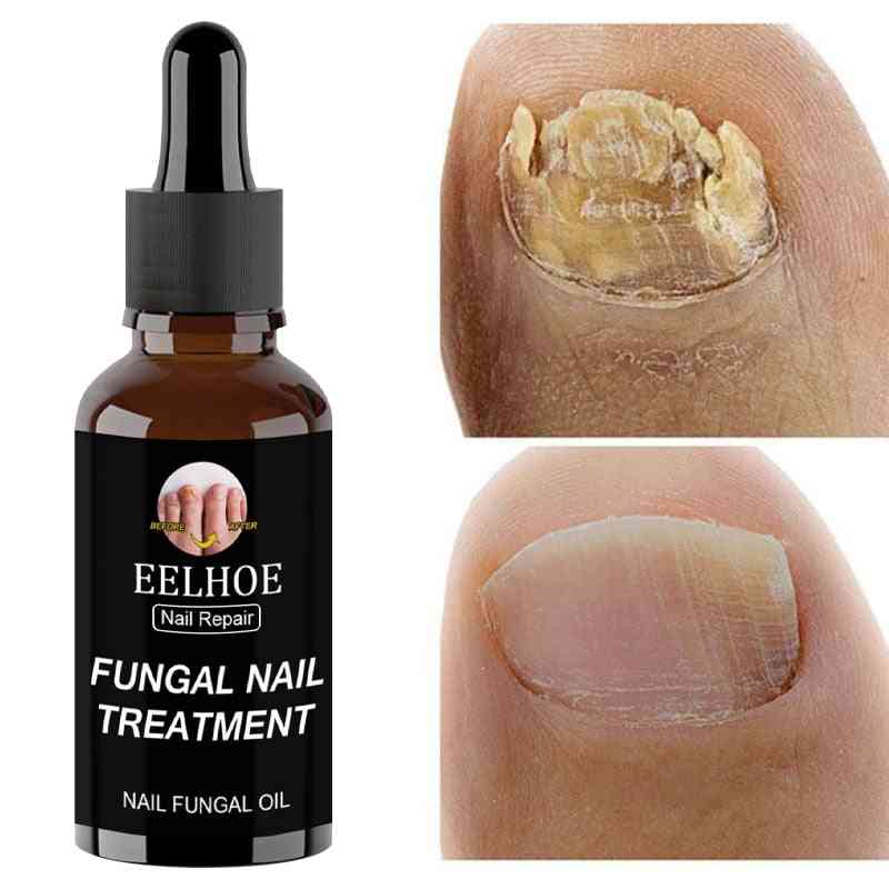 Fungal Nail Repair Essence Nourishment Oil